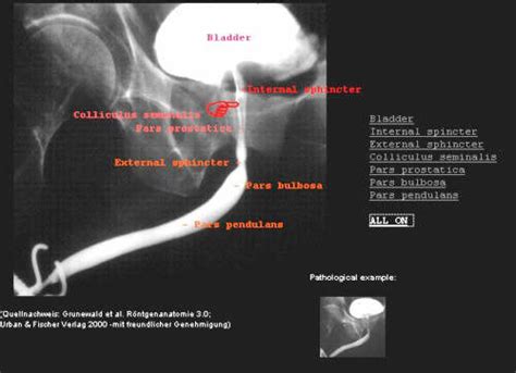 mcu full form medical|Micturating cystourethrogram (MCUG) .